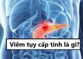 Viêm tụy cấp tính là gì?