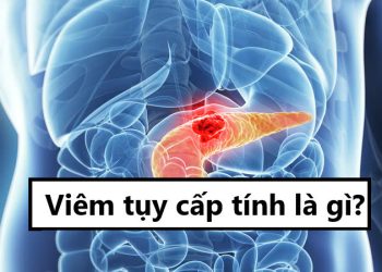 Viêm tụy cấp tính là gì?