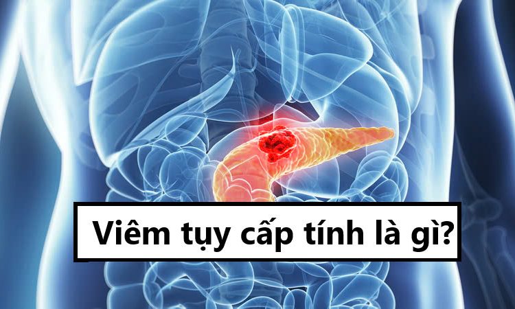 Viêm tụy cấp tính là gì?