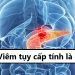 Viêm tụy cấp tính là gì?