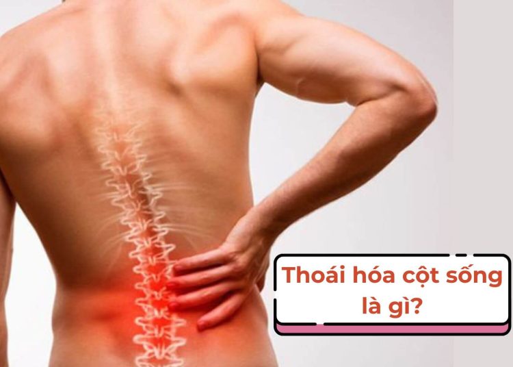 Thoái hóa cột sống là gì?