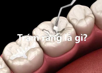 Trám răng là gì?