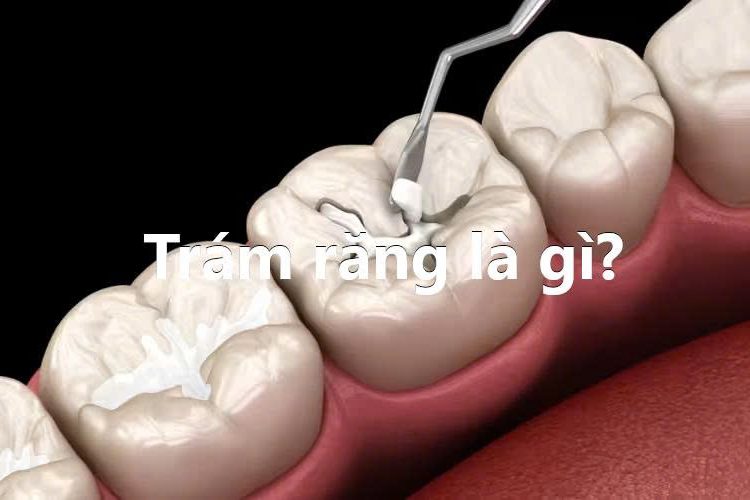 Trám răng là gì?